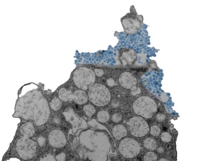 microscope image of nasal epithelial cell releasing rhinovirus (blue)