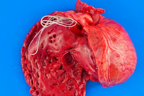 A dog's heart with heartworm