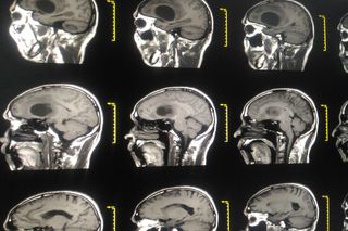 a brain scan showing glioblastoma 