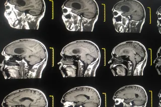 a brain scan showing glioblastoma 