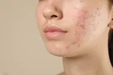 young person with acne on their cheek and chin 