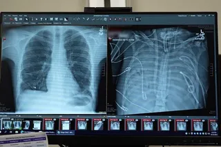 Chest x ray images of the patients new and old lungs 