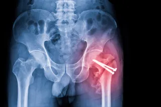 X-Ray image of a broken hip with pins in it