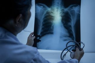 Doctor looking at a scan of a person's lungs, possibly for TB