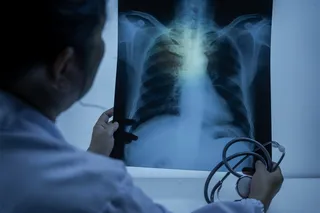 Doctor looking at a scan of a person's lungs, possibly for TB
