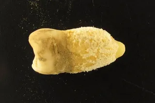 Ancient human tooth from a Bolivian mummy containing Streptococcus pyogenes, the bacterium responsible for scarlet fever.