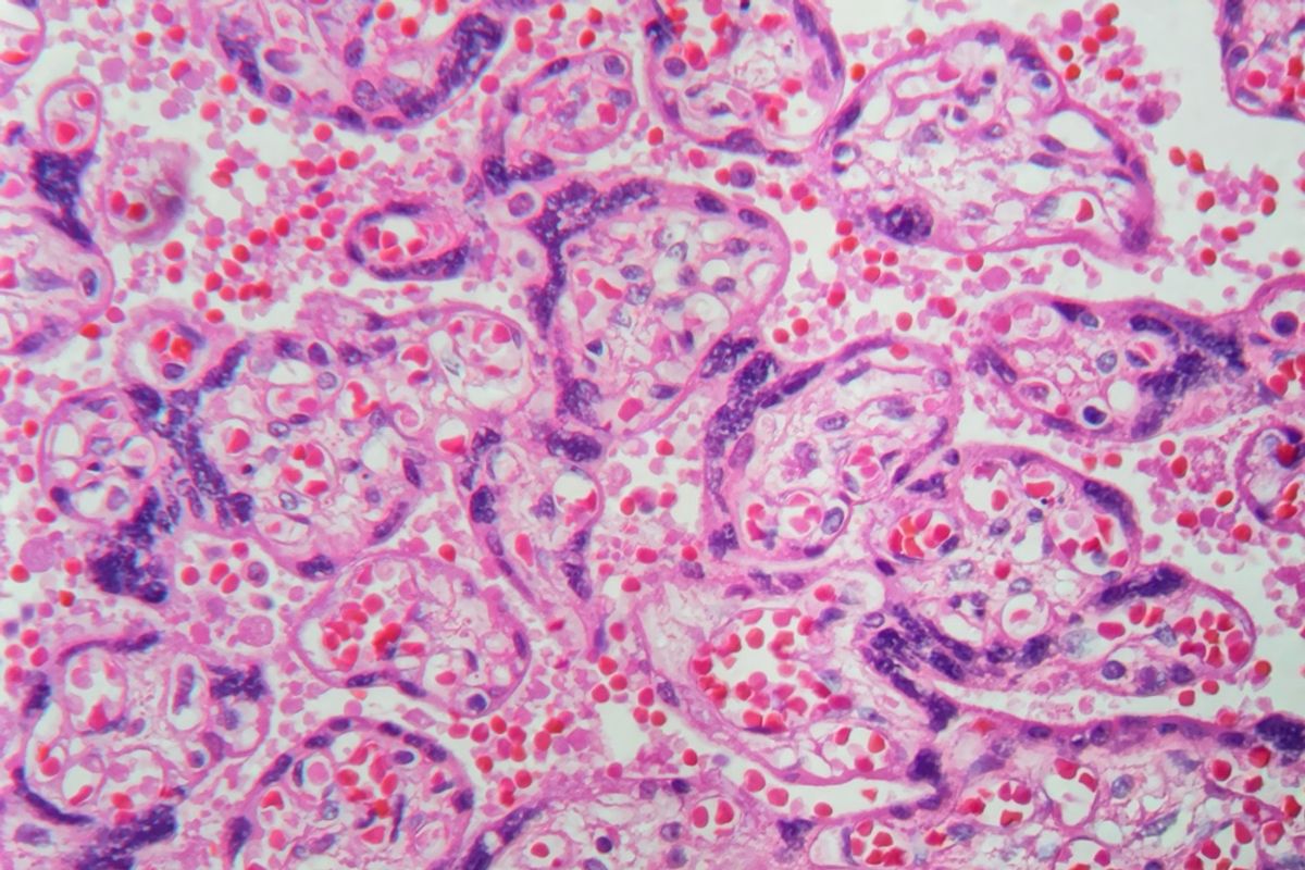 Preeclampsia Has Existed for Roughly 5,000 Years, but There Is Still No Cure — Why Is It Called the 