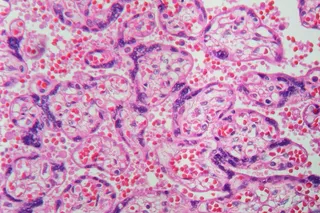 micrograph of placental tissue shows syncretial knotting, resulting from preeclampsia