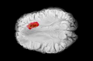 red spot glioblastoma in a brain scan