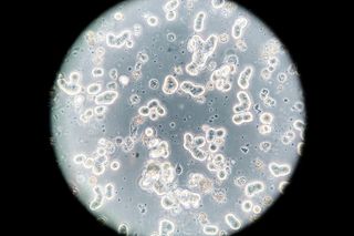 Breast cancer cells under a microscope