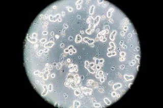 Breast cancer cells under a microscope