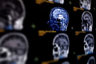 Image of a brain scan, potentially showing brain cancer