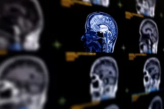 Image of a brain scan, potentially showing brain cancer
