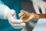 Otzi's arm, the iceman mummy's microbiome research
