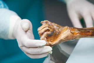 Otzi's arm, the iceman mummy's microbiome research