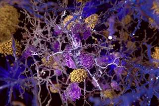 amyloid plaques in yellow