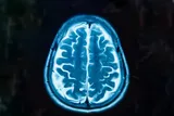 blue and black image of an MRI brain