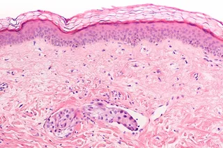 Inflammatory breast cancer pathology