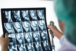 A doctor reviews knee MRI scans related to knee osteoarthritis and genicular artery embolization treatment.