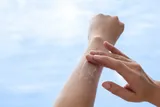Person applying sun screen to avoid skin allergy from the sun