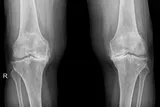 X-ray image of knees with osteoarthritis 