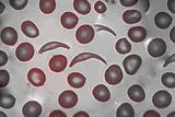 Sickle cell anemia under the microscope