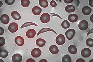 How a CRISPR Gene Therapy Could Change Life for Young Children With ...