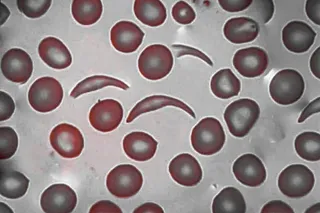 Sickle cell anemia under the microscope