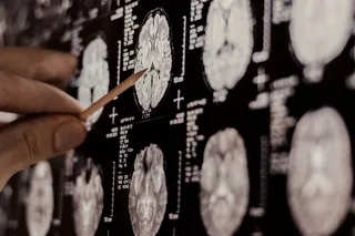 Doctor examines brain scans