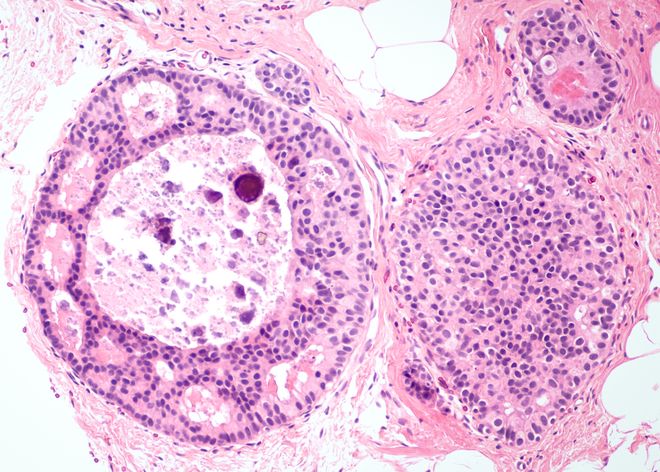 Breast cancer core biopsy Breast cancer core biopsy