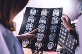 5 recent dementia breakthroughs, doctors looking at a brain scan 