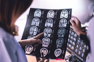 5 recent dementia breakthroughs, doctors looking at a brain scan 