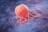 cancer cell spreading in a person