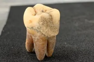 human tooth from ancient Japan