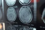 Brain MRI scans illustrating research linking recreational drug use to increased stroke risk in younger adults.