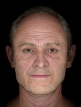 facial reconstruction t