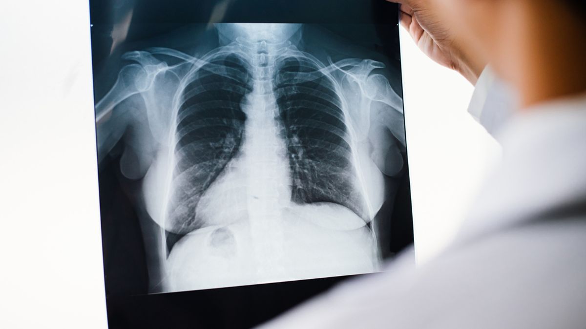People With Lung Cancer Had Higher Levels of Microplastics in Their Lungs