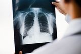 People With Lung Cancer Had Higher Levels of Microplastics in Their Lungs