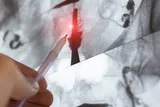 X-ray of a female uterus
