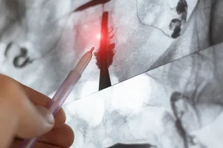 X-ray of a female uterus