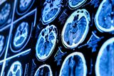 The Brain May Be Two Organs, a Discovery That Could Advance ALS Research