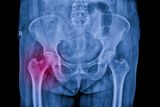 hip fracture t