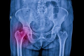 x ray image showing a hip fracture 