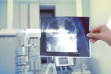 X-ray of potential silicosis from quartz countertops