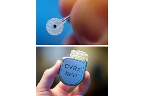 Bloodflow Implant - CVRx