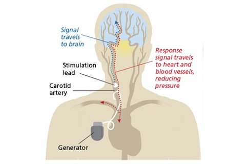 bioelectronic graphic - CVRx