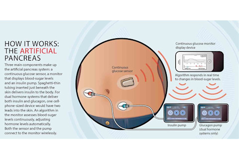 artificial pancreas