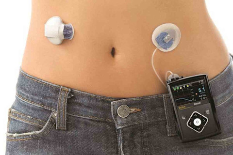 Medtronic's MiniMed 640G Insulin Pump
