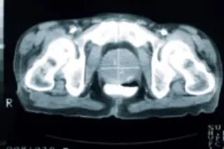 pelvis xray enlarged prostate